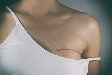 Double Mastectomy Scars: What to Expect and How to Support Healing